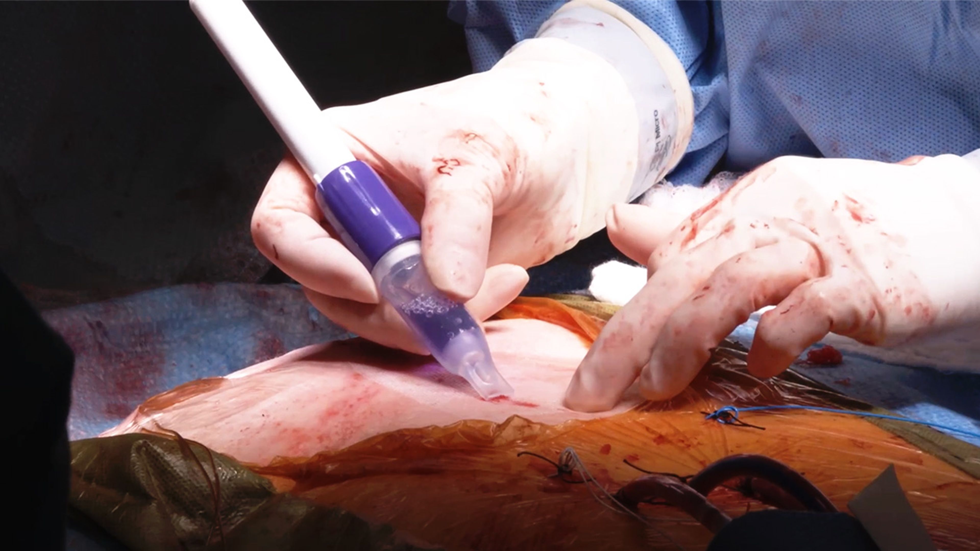 US_ETH_WOUN_110792.1 - DERMABOND™ PRINEO™ Skin Closure System in cardiac surgery: Retrospective study with Bob Kiaii, MD