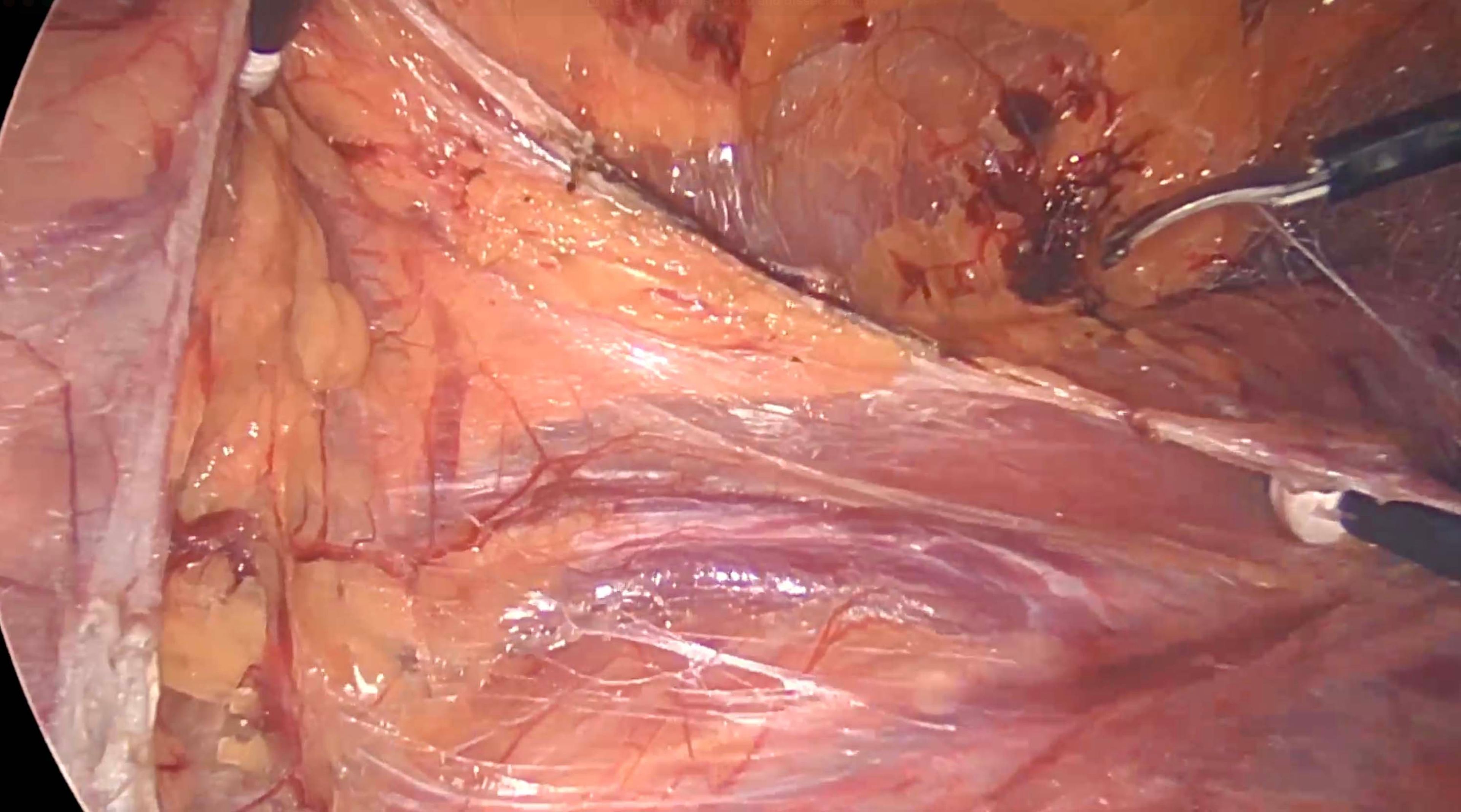ureter is traced and dissected