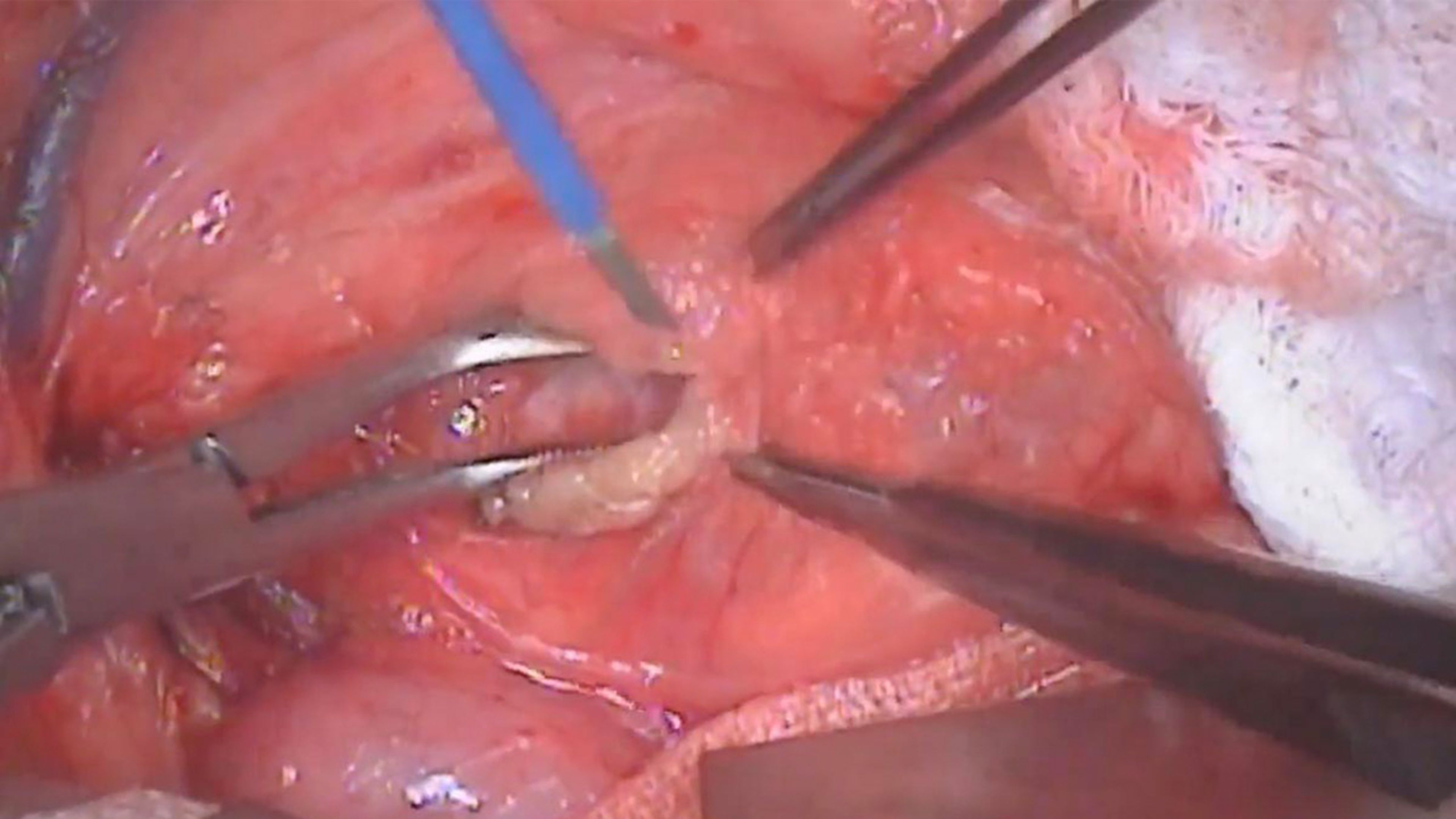 Aorta exposed