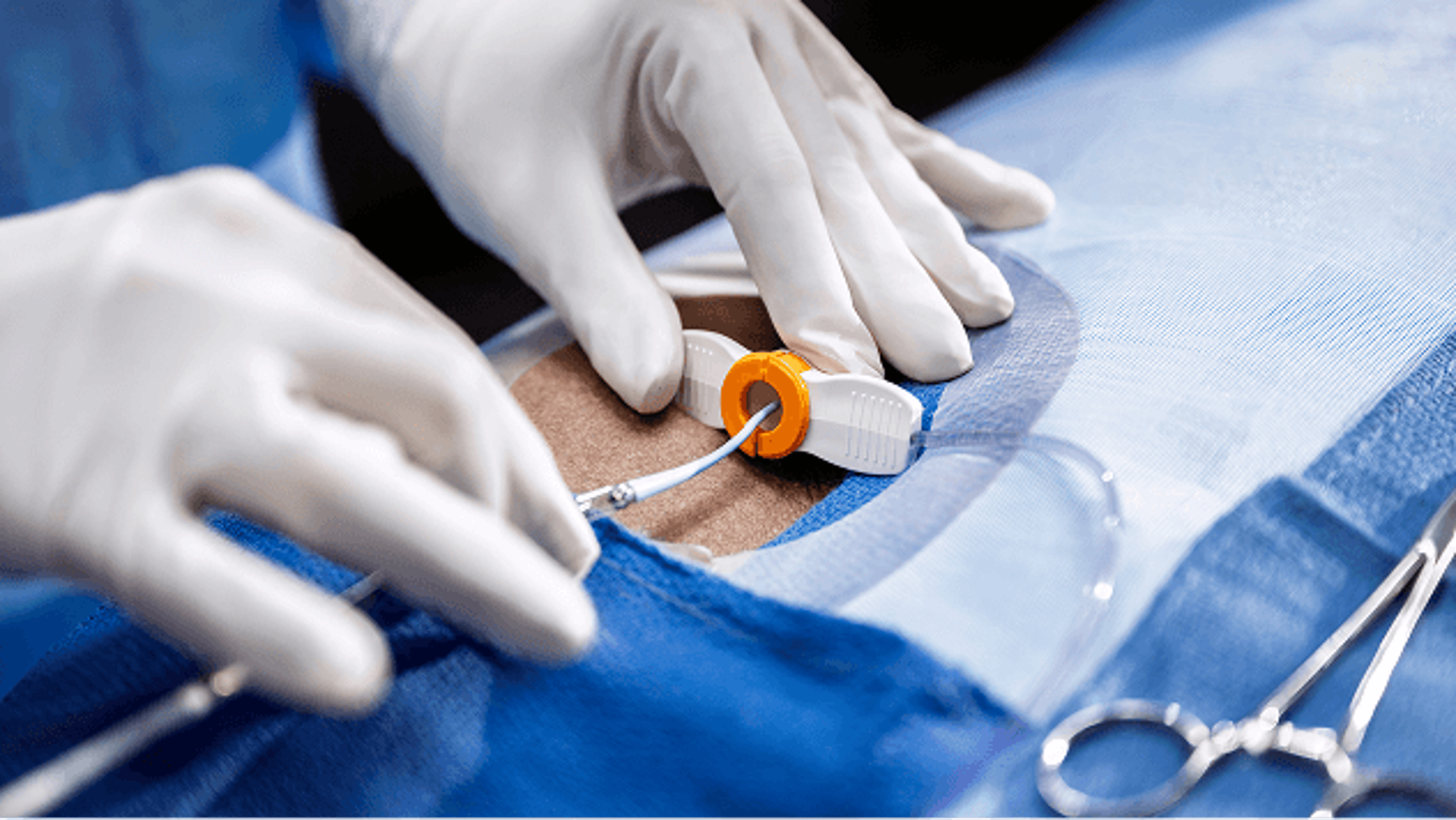Close-up of gloved hands inserting the Impella catheter through a sheath in the patient’s groin during an endovascular procedure. The inlet portion of the catheter is visible alongside sterile drapes and instruments.