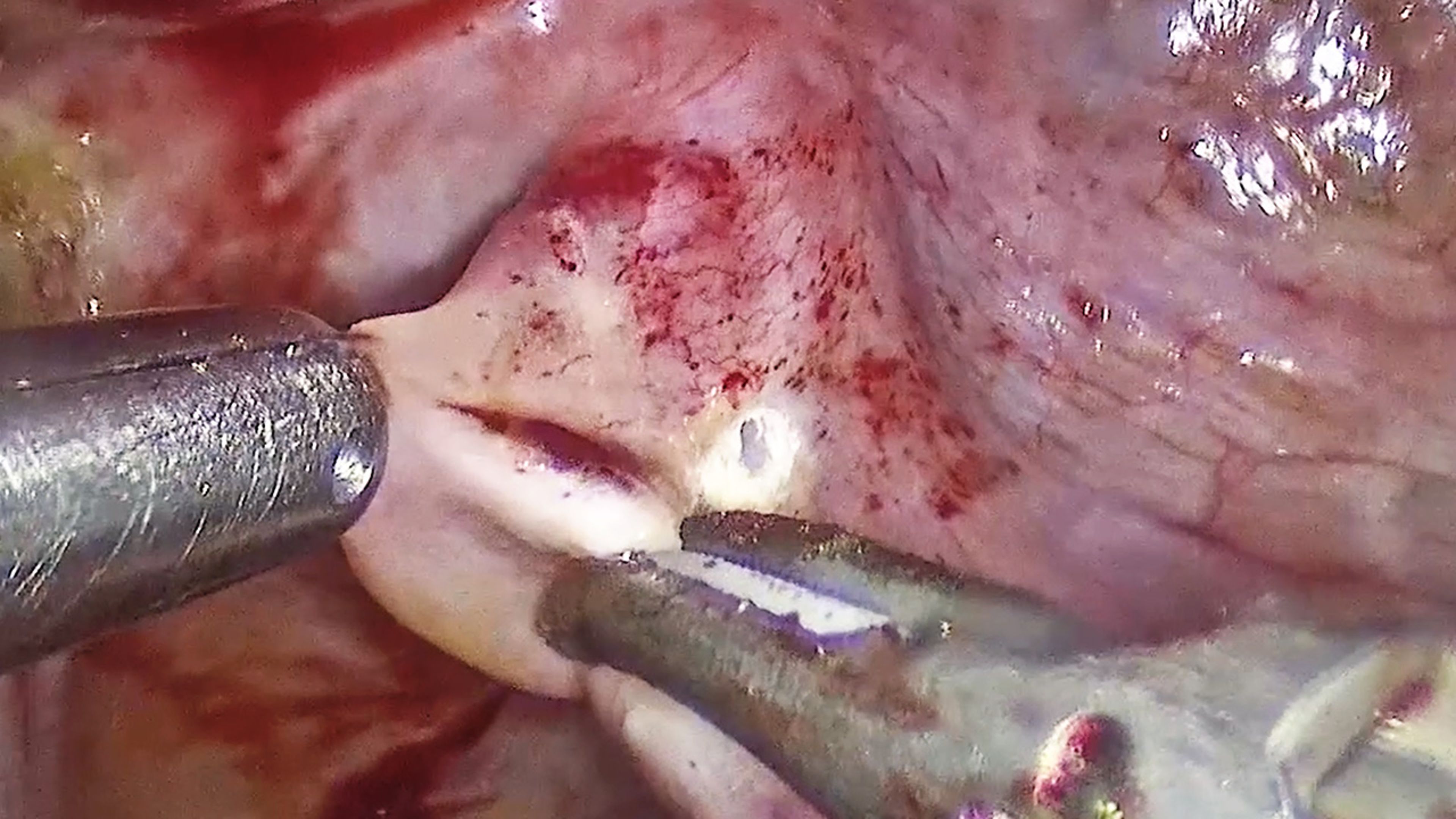 US_SRG_ENER_401018 - Excision of endometriosis using HARMONIC™ 1100 Shears and GYNECARE INTERCEED™ Absorbable Adhesion Barrier with Kirsten Sasaki, MD