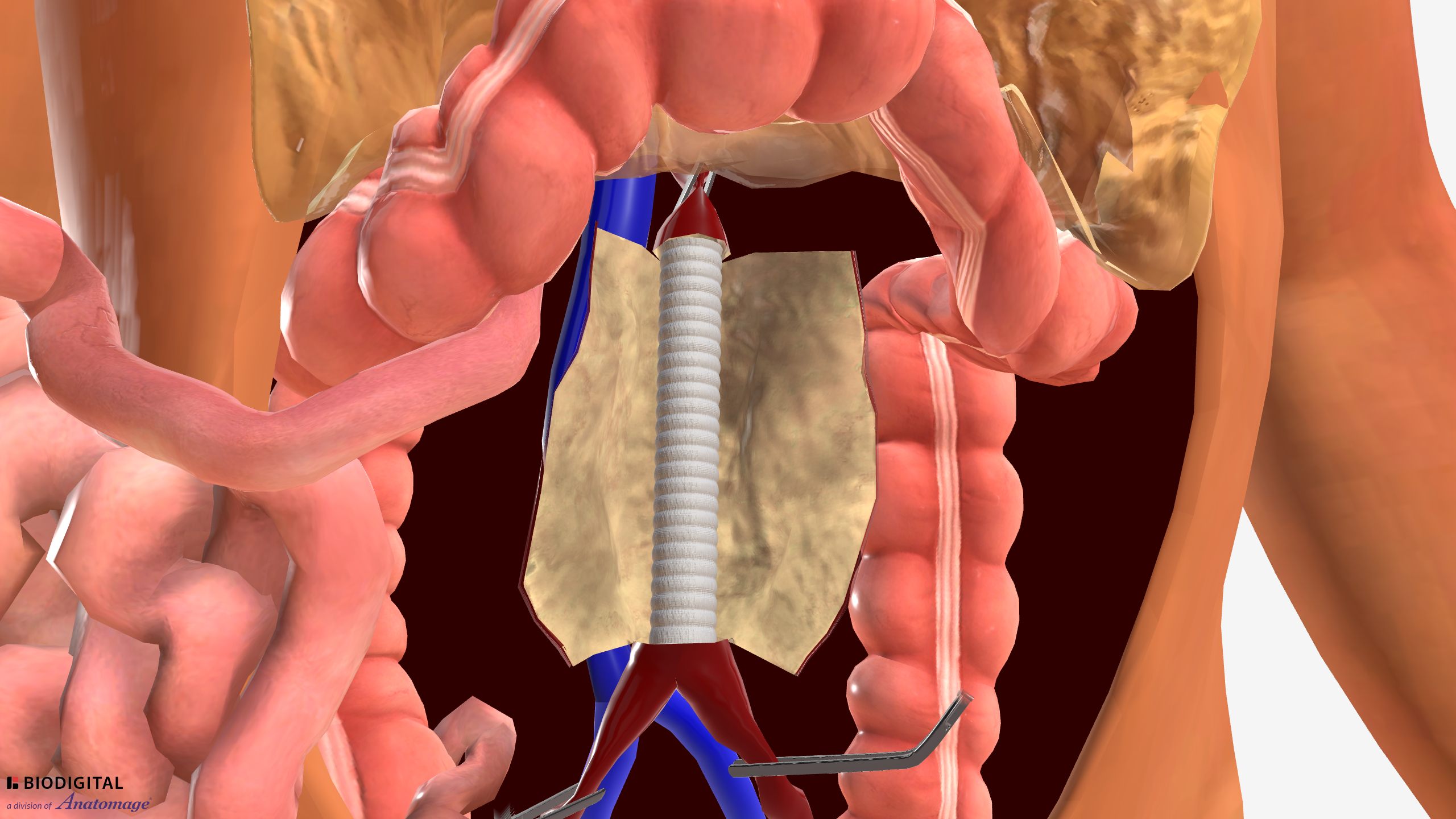 3D interactive tool for Aortobifemoral bypass