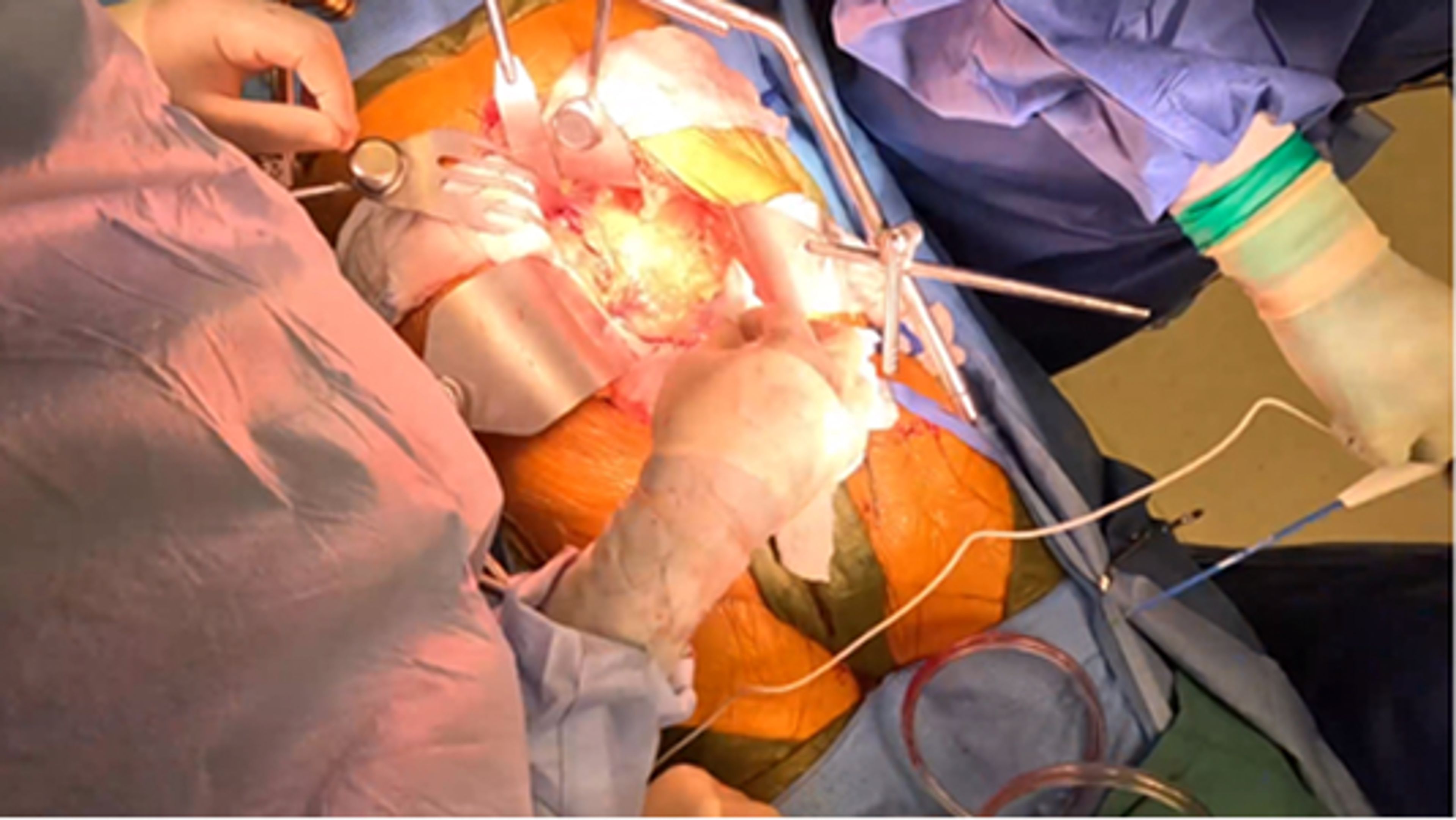 Aortobifemoral bypass