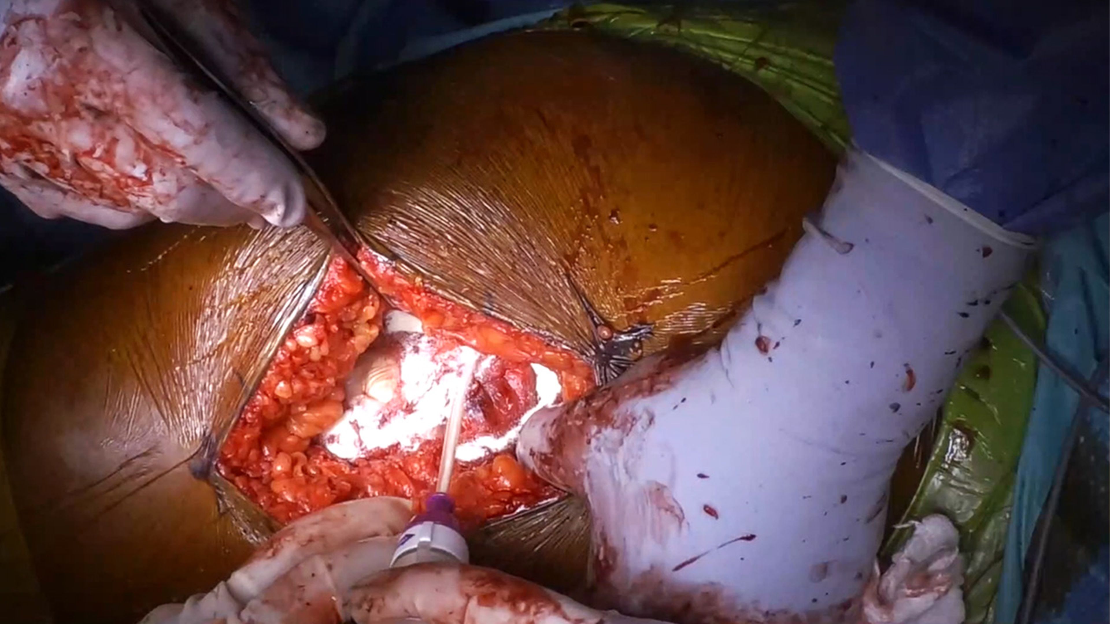US_ETH_BIOS_387321 - Total Hip Arthroplasty Closure using SURGICEL™ Powder Absorbable Hemostat with Michael Muncy, DO
