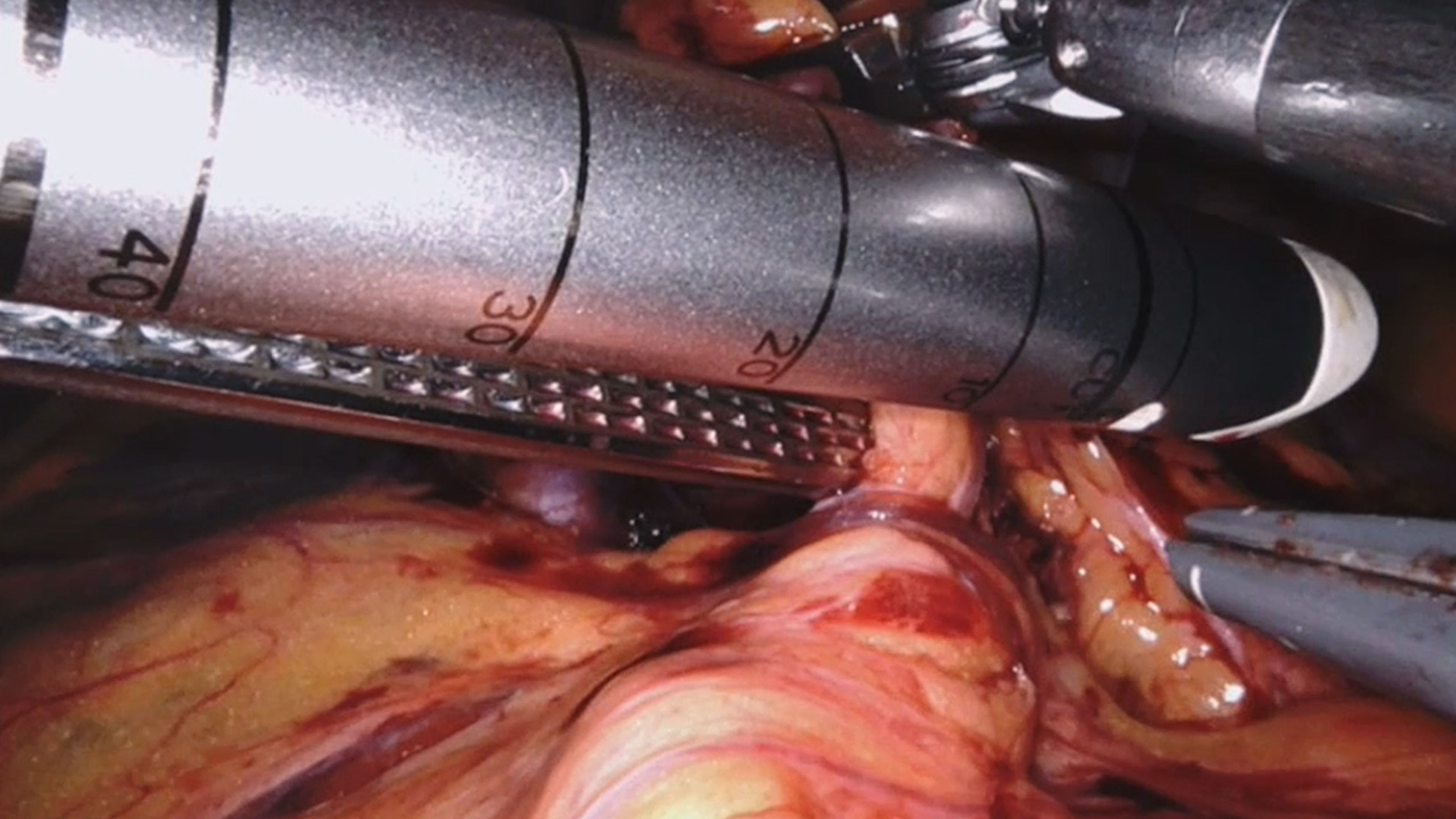 US_SRG_STAP_403230	Avoiding anastomotic leaks during esophagectomies with Olugbenga Okusanya, MD