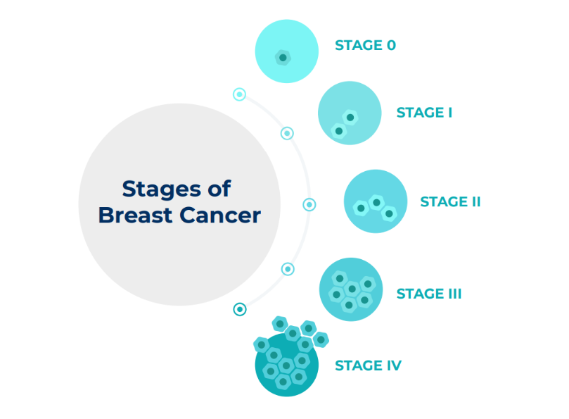 Stages if Breast Cancer