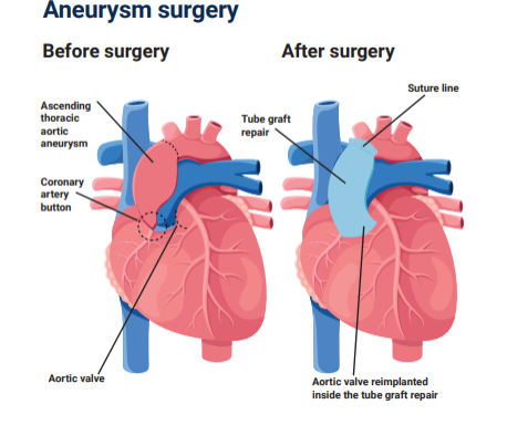 Aneurysm surgery diagragm