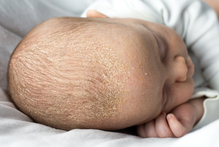 pillar_miwi_baby_hautprobleme_milchschorf_BR-PCL37-22-CP381.jpg