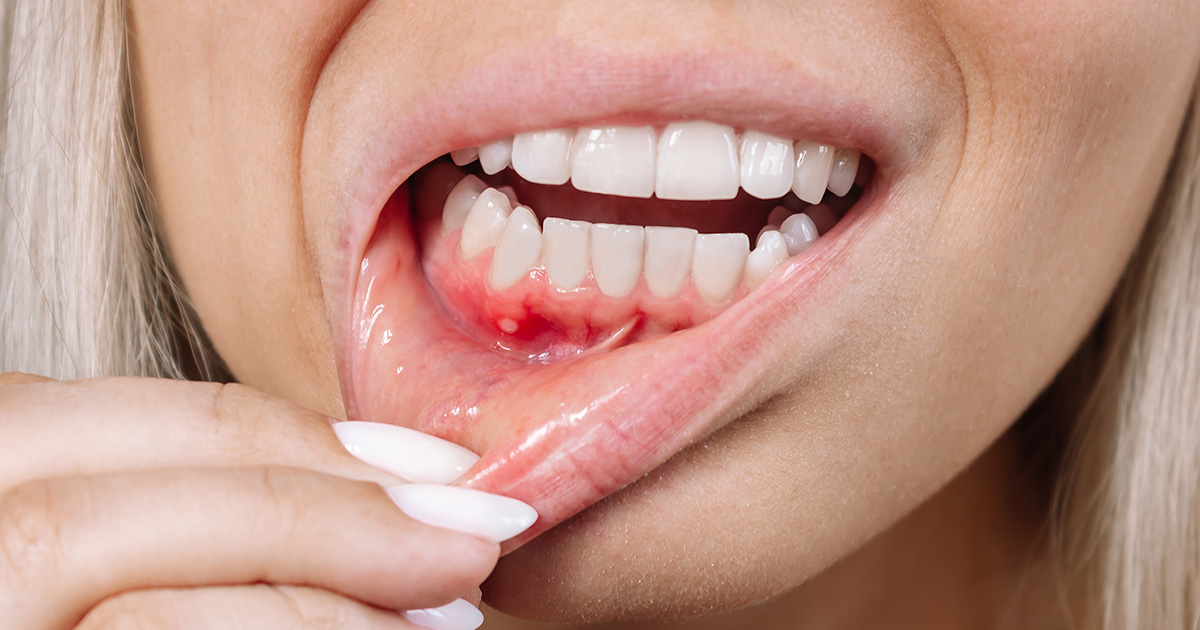 Aphten Was tun gegen die schmerzhaften Bläschen im Mund