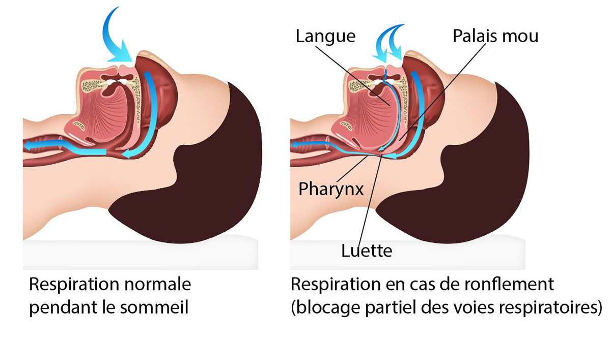 Ratgeber-Schlaf-Entspannung-Schnarchen-Infografik-FR.jpg