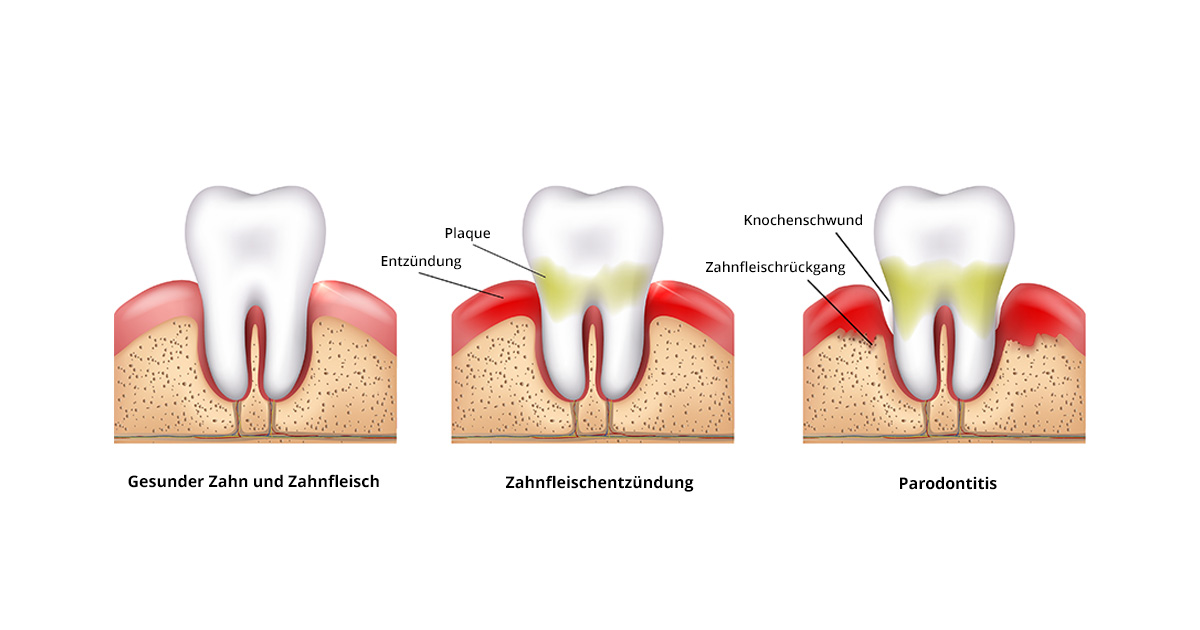 Zahnfleischentzündung richtig behandeln