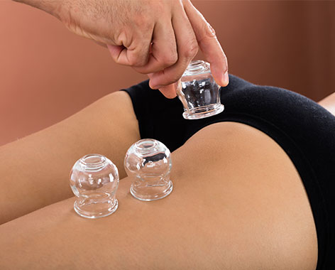 Cellulite Schroepfen am Oberschenkel