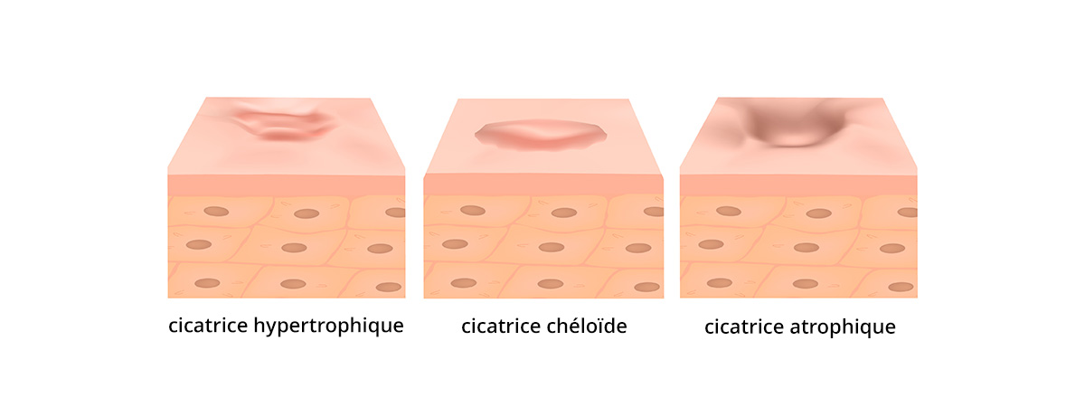 Le Soin Des Cicatrices En Toute Simplicité: Atténuer Et Soigner Les ...