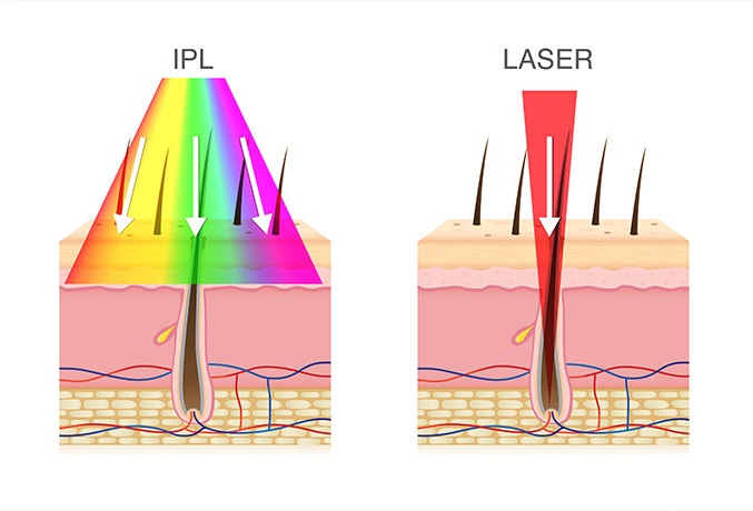 Unterschied IPL und Laser