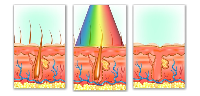 Die Funktionsweise von IPL schematisch dargestellt