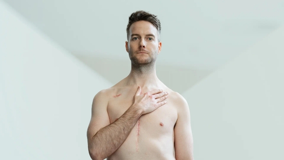 Geoff Lester standing with bare chest, hand on heart, heart surgery scar
