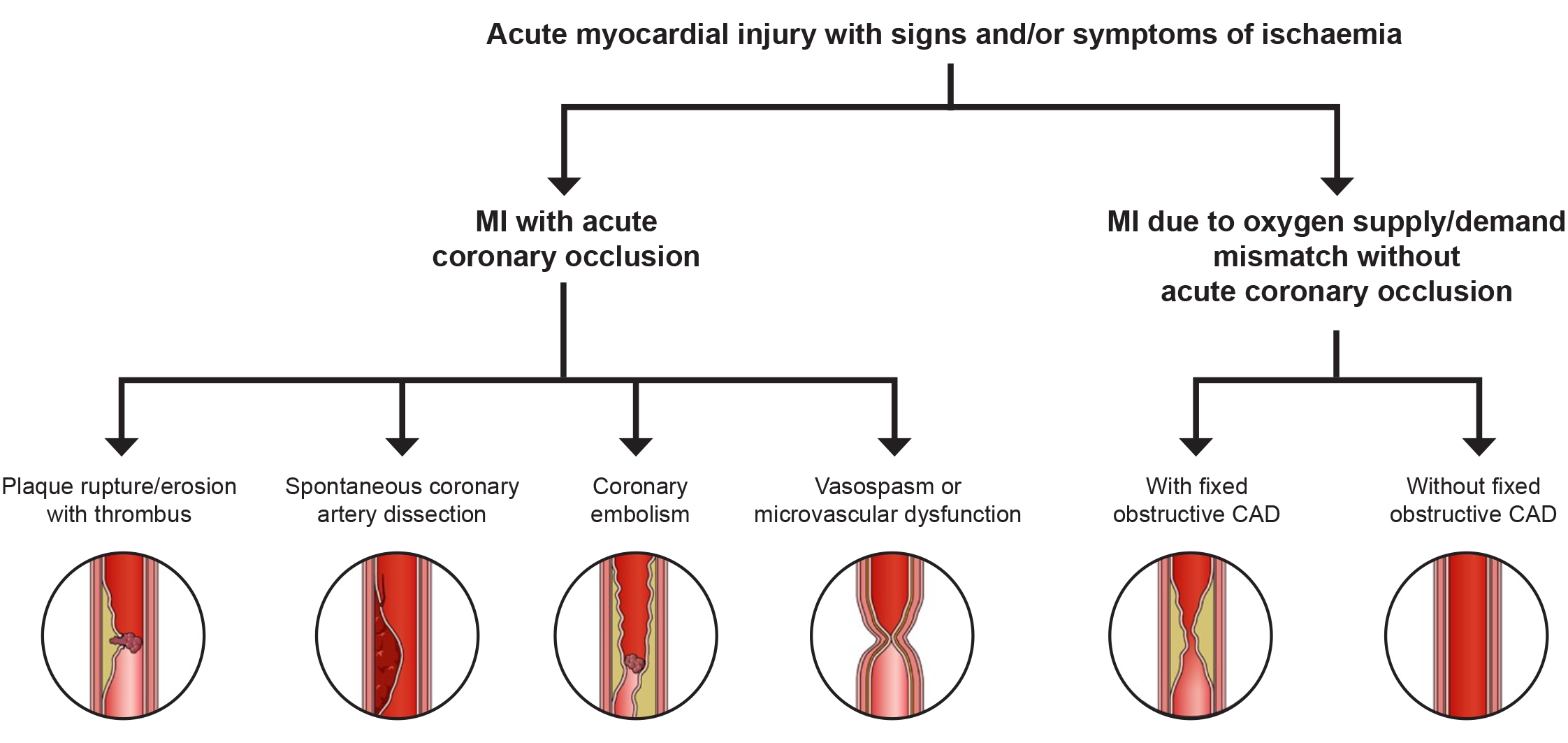 Figure 2 Revised classification of MI