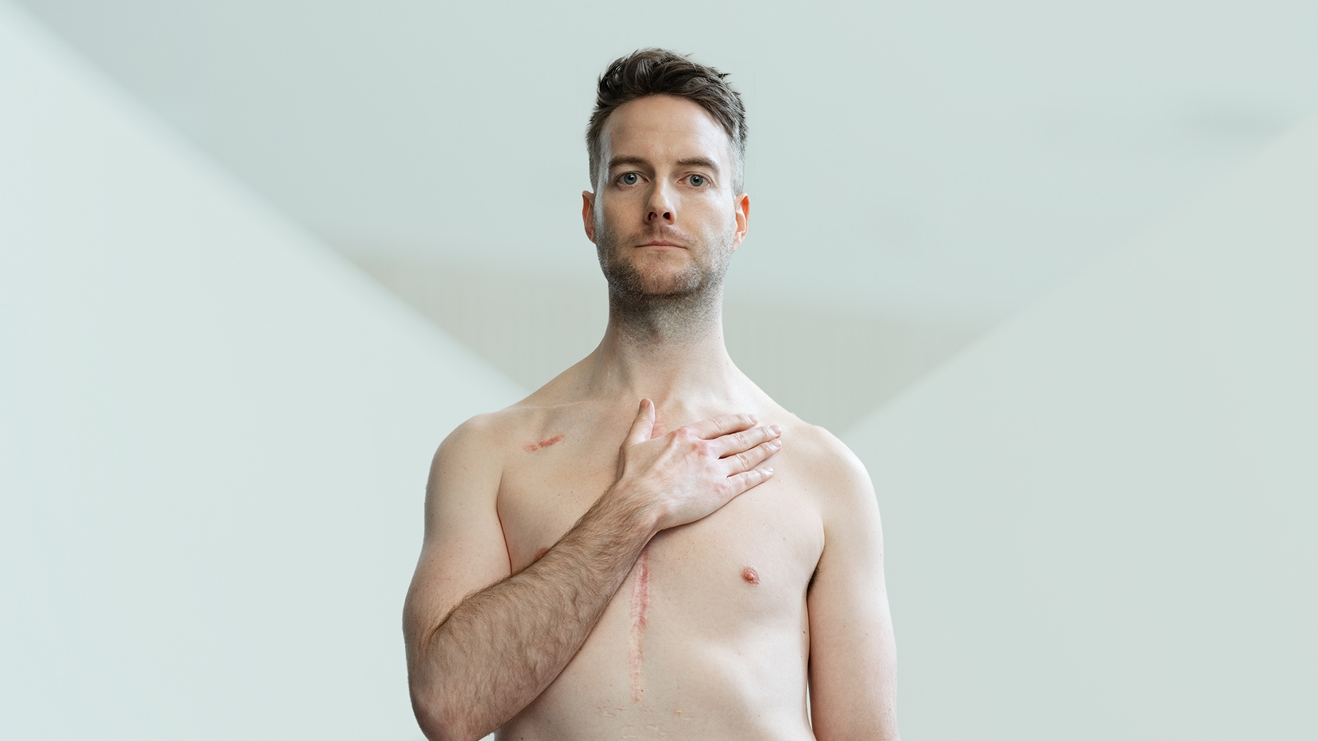 Geoff Lester standing with bare chest, hand on heart, heart surgery scar 