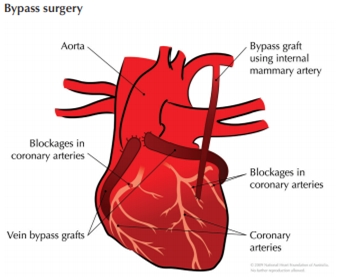 Diagram of the heart and major arteries, illustrating the intricate network of blood vessels within the human cardiovascular system.