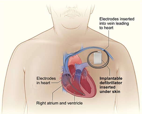 Visual representation of the heart's electrical system, showcasing its complex network.