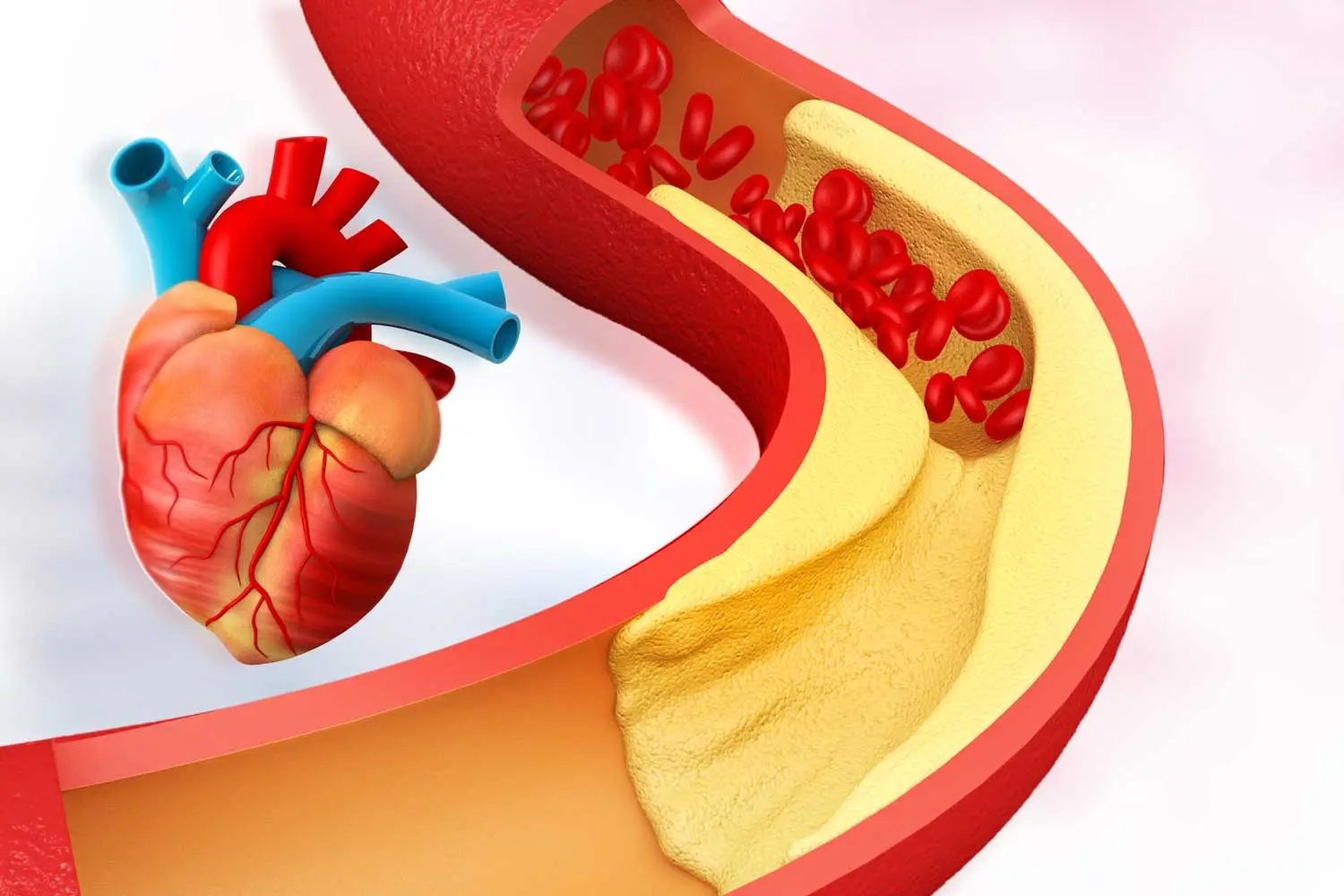 How cholesterol can affect heart health, blocked arteries with human heart