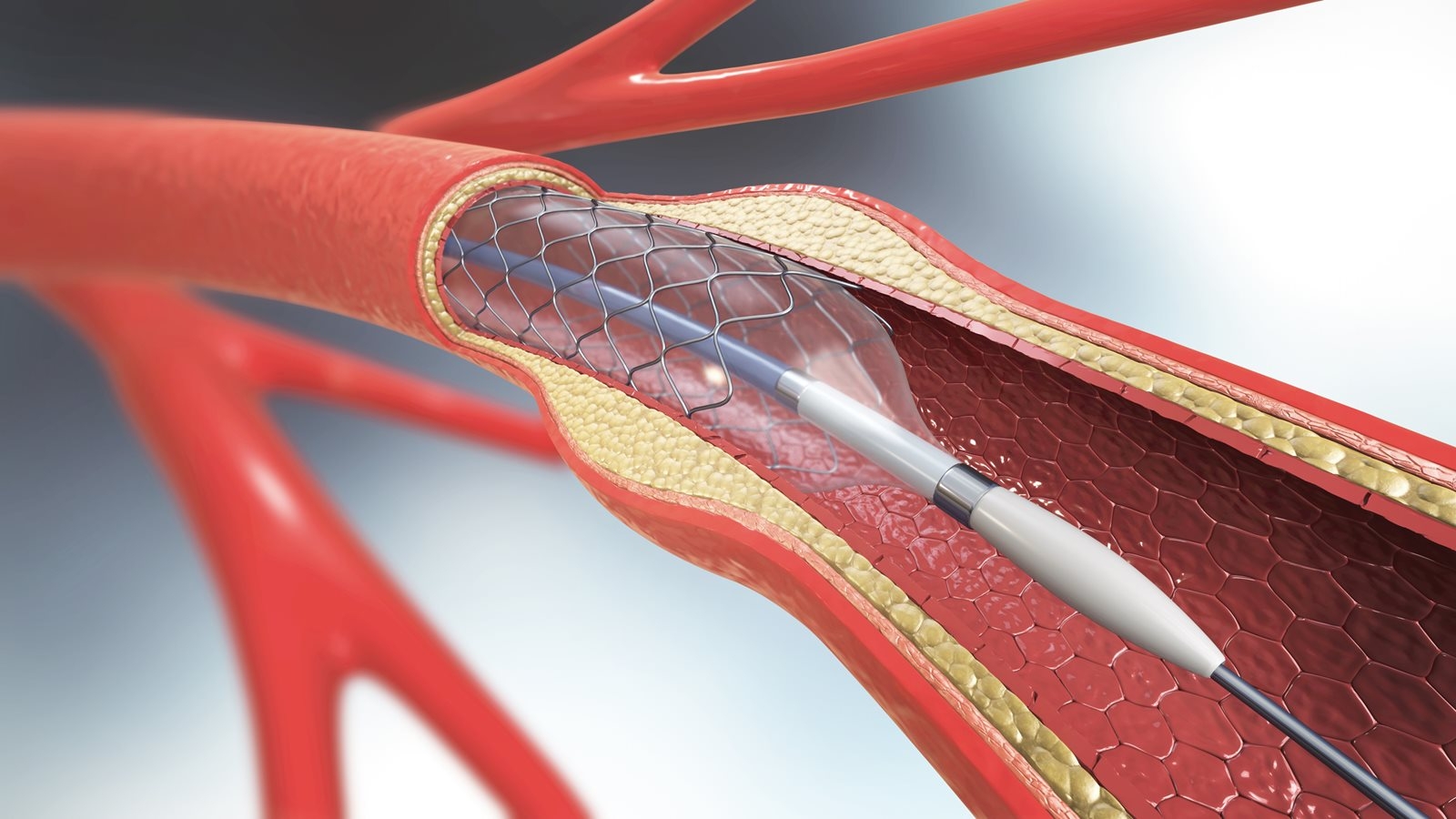 graphic depiction of internal heart showing heart stent