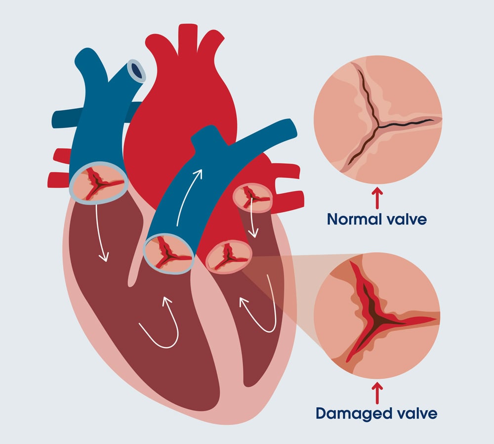 Healthy vs unhealthy heart valve graphic