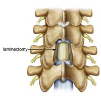 spinal decompression diagram