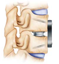 cervical disc arthroplasty diagram