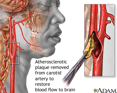 Endarterectomy graphic