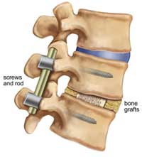 spinal fusion diagram