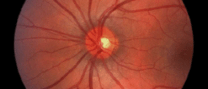 macular-disease-condition-factsheet-blackmores-institute-663x285.gif