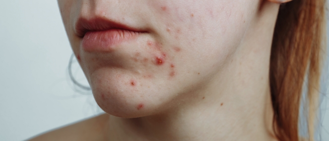 acne.jpg