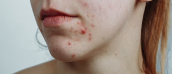 acne.jpg
