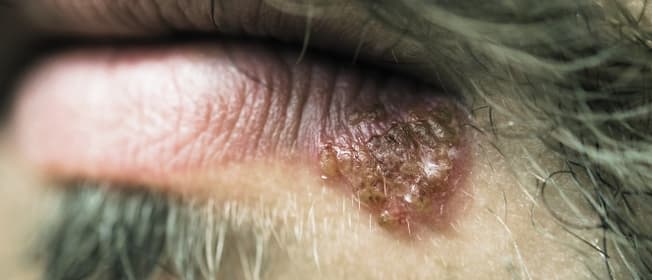 cold-sore-factsheet.jpg