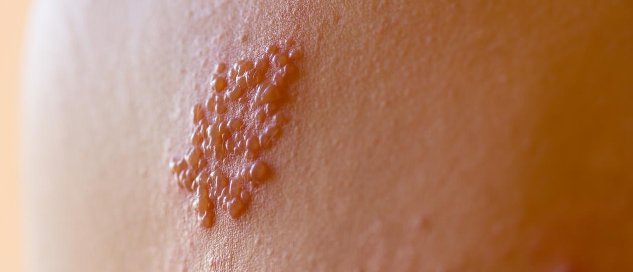 the-rising-reactivation-of-shingles-1260x542.jpg