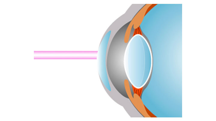 レーザーを照射して、角膜のカーブの形状を変化させる