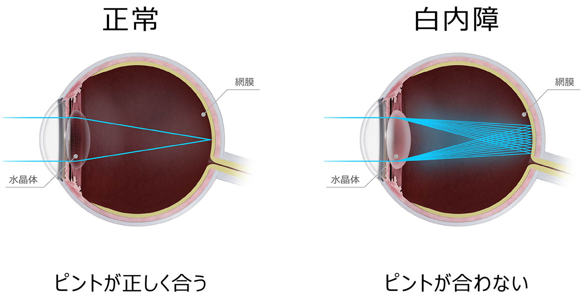 ピントが合わないと、ぼけたり、かすんで見えてしまいます！