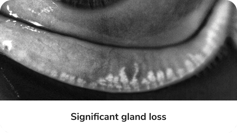 Gland loss image