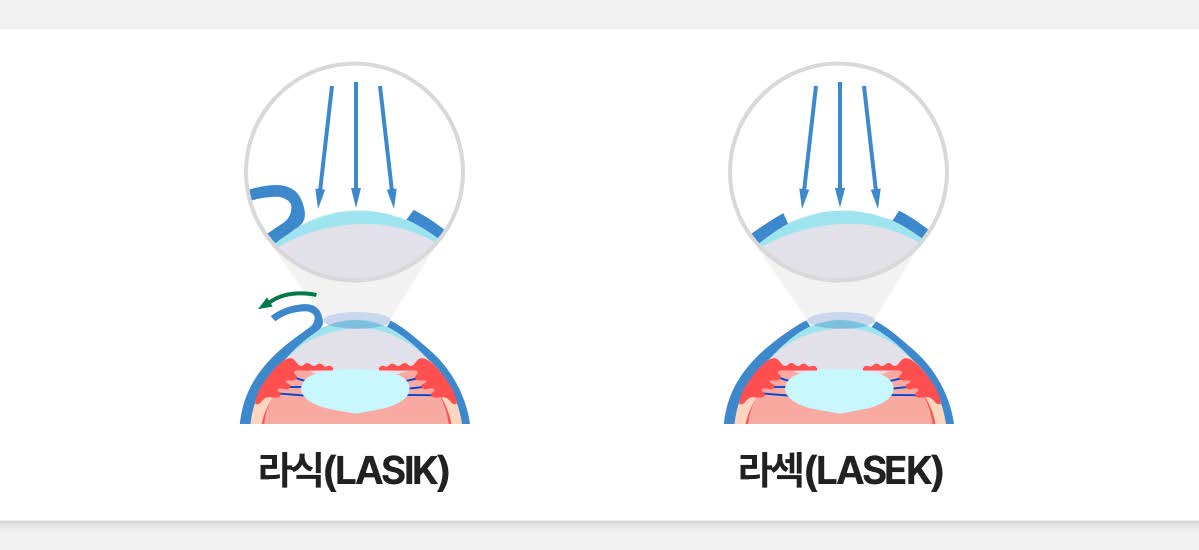 라식/라섹 예시 이미지