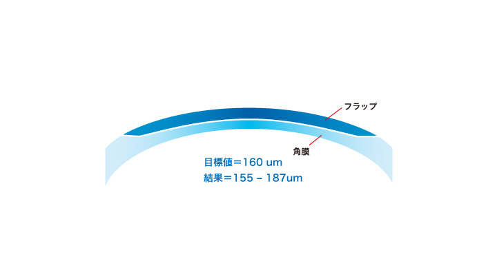 フラップの厚さ マイクロケラトームの場合 : 約100～160μm（マイクロメートル）