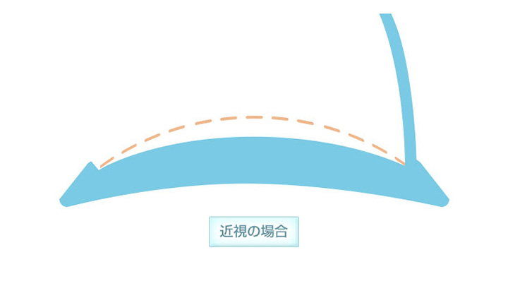 角膜を削る量　近視の場合