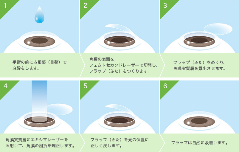 The LASIK最新屈折矯正手術の実際 強度近視眼の屈折矯正手術 – 目医者情報