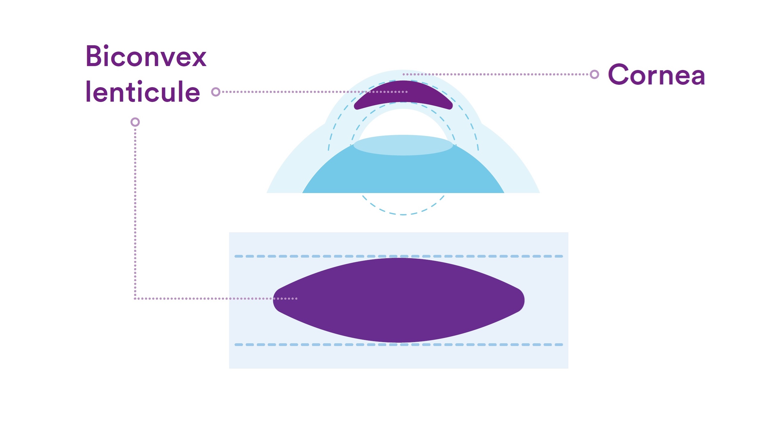 Biconvex Lenticule Inside the Cornea – Diagram Illustration showing a biconvex lenticule within the cornea.