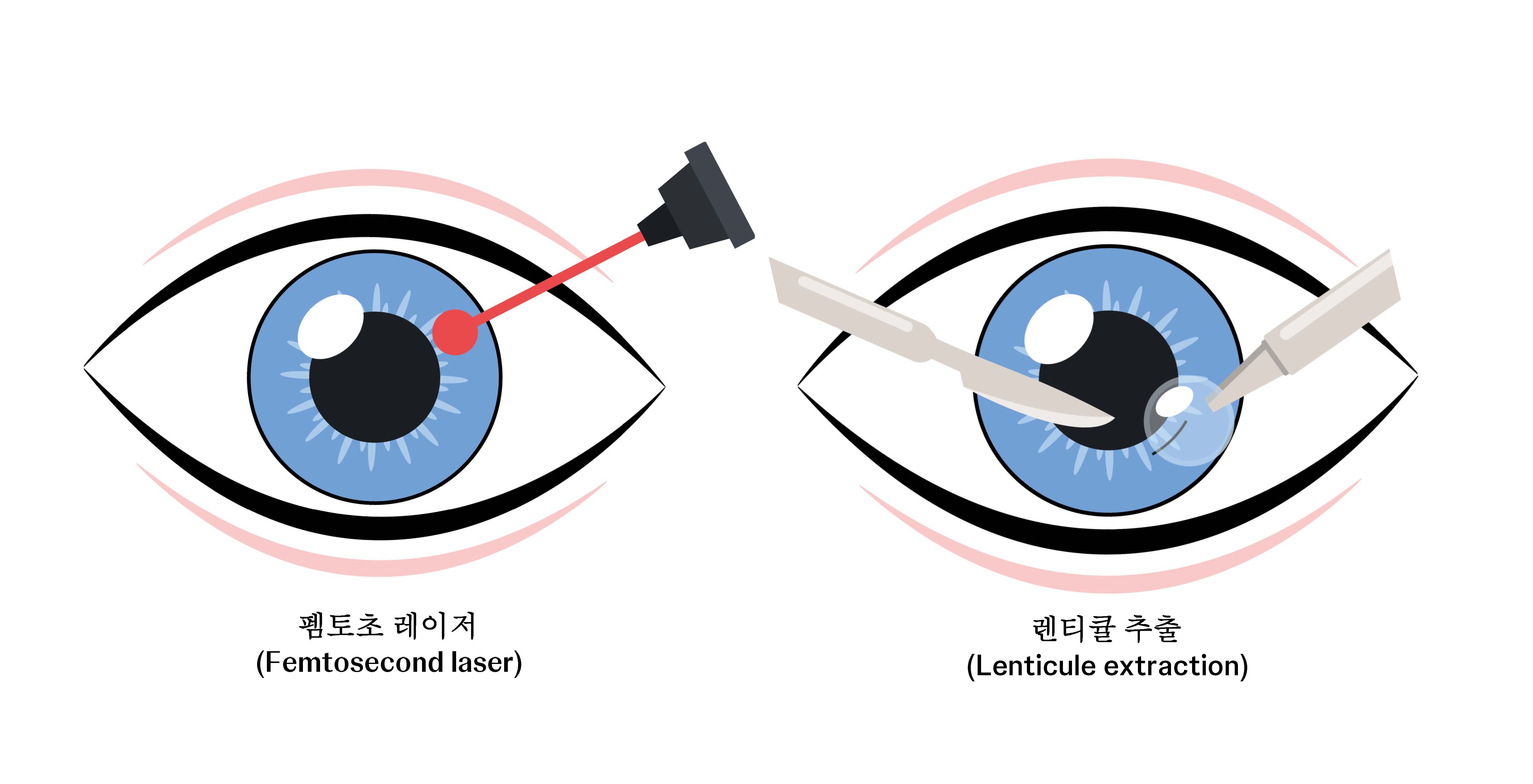 Procedure of lenticule extraction surgery
