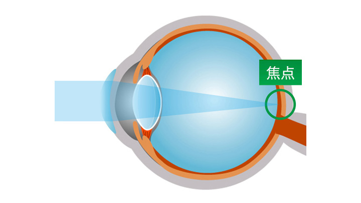 屈折の角度が変わり、光が網膜の一点上で焦点を結ぶ