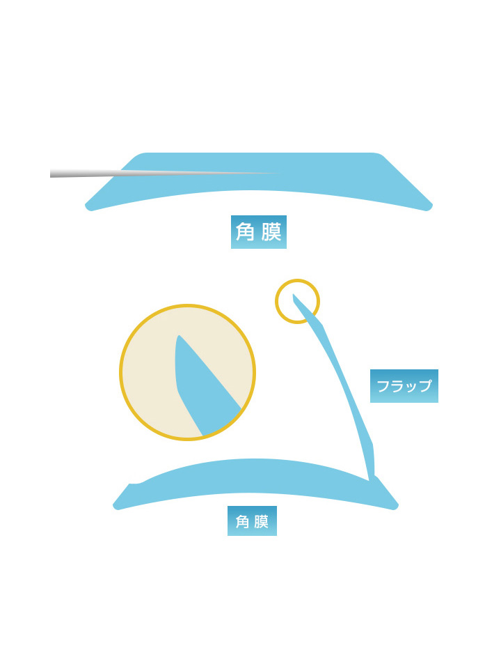 一方向（水平）カットによるフラップ作製（マイクロケラトーム）の場合