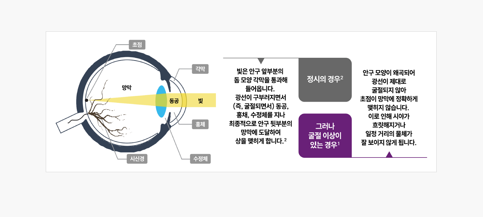 굴절이상의 원리