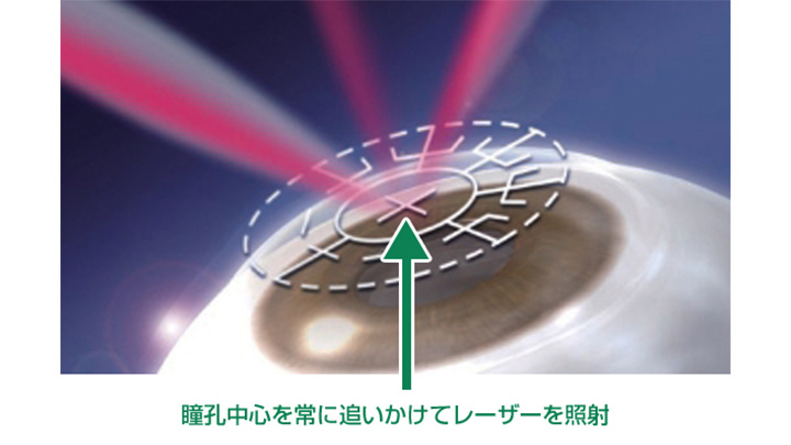 アイトラッキング 瞳孔の中心を常に追いかけてレーザーを照射