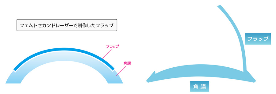 ウェーブフロントマップ 眼球に光をあてて網膜から返ってきた光の歪みを波面（ウェーブフロント）としてセンサーで計測